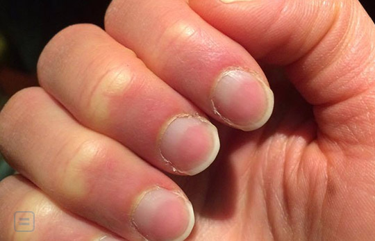Why are nails harder than hair if both are made from keratin?